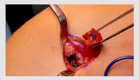 Biopsies Soft Tissue Bone