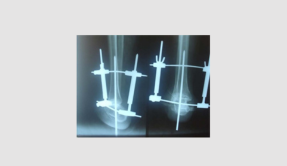 Boyds Arthrodesis