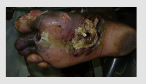 Necrotising Fasciitis leg