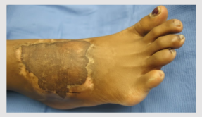 SSG _ Skin Grafting of Foot _Lower Limb Grade I III