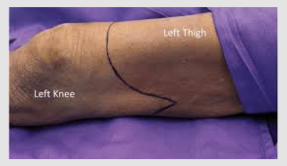 above knee